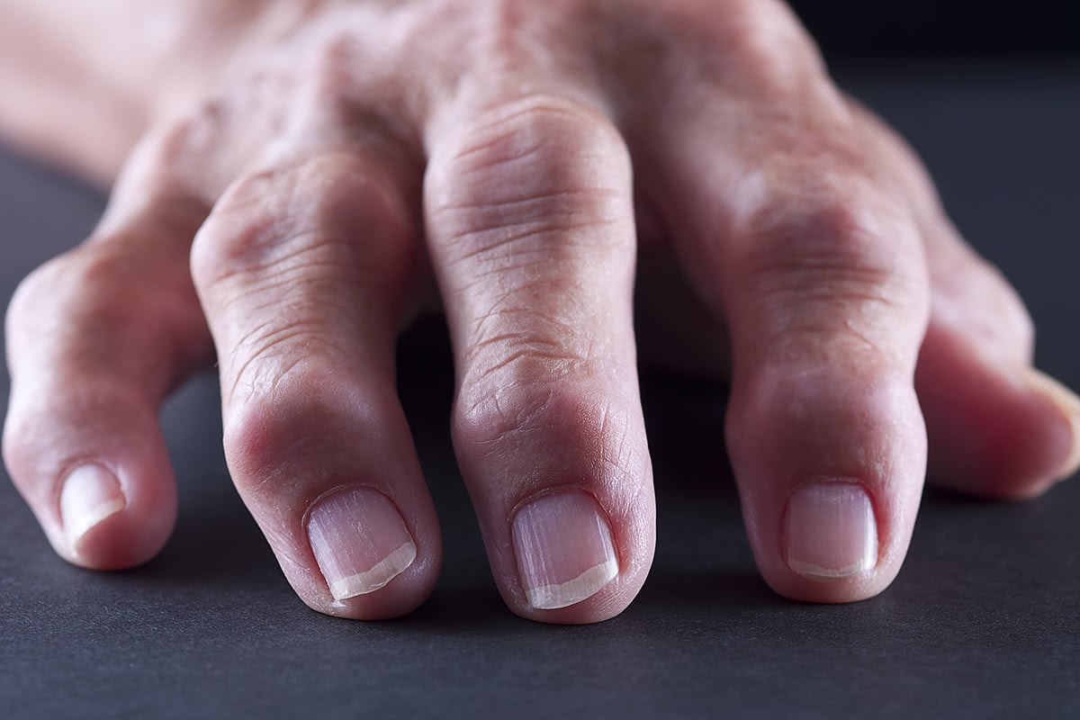 finger-arthritis
